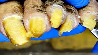 The Complete Trimming Process Of Onychomycosis, Each Nail Is Restored To Health【Podiatry Clinic】