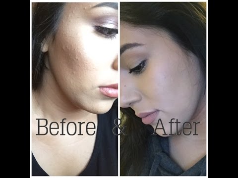 Big Painful Pimple On Cheek Must Watch Red Bumps Under Skin Acne