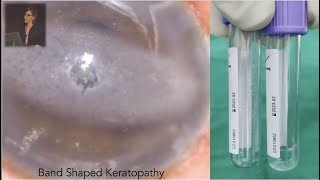 EDTA Chelation for Band Shaped Keratopathy - the Preparation and the Technique