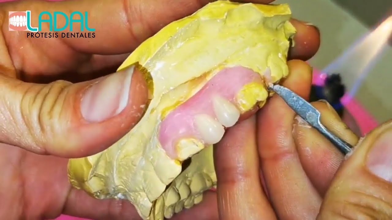 Encerado De Prótesis Dental Flexible Unilateral #2 - YouTube