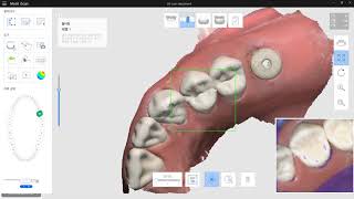 Case1 #1  scan 26 scan abutment with Medit Link(i500)