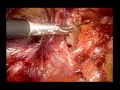 large inguinal hernia repair with e tep technique.wmv