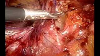 LARGE  INGUINAL HERNIA REPAIR WITH E-TEP TECHNIQUE.wmv