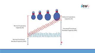 Progression of Dynamic Hyperinflation Syndrome on Mechanical Ventilation