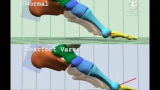 Comparison of Normal Gait to Rearfoot Varus Gait