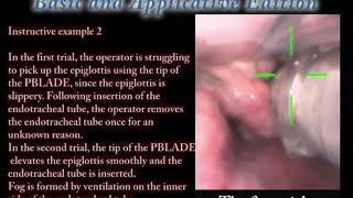 Video Laryngoscope Airway scope(AWS) - Basic and application edition instructive example 2