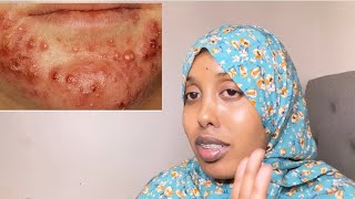 Noocyada nabraha ama finanka iyo sidaa iska yareen karto. ( types of acne on the face)