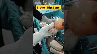 टूटी हुई  कूल्हे Hip की गोल हड्डी | फ्रैक्चर Neck femur |#hipbone #hiprehab #hipreplacementsurgery |