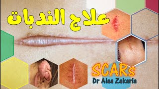 علاج الندبات..الفرق بين الندبة والجلد الطبيعي.. || Scar managements