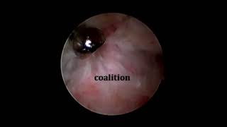 Endoscopic Resection of a Talocalcaneal Coalition Using a Posteromedial Approach