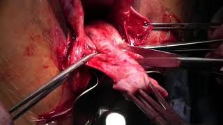 Prolaps Surgery : vaginal Plastron  + Sacrospinous ligament fixation \