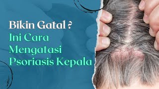 Psoriasis Kulit Kepala : Penyebab dan Cara Mengatasinya #psoriasis #kulitkepala #caramengatasi