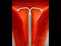 How Hormonal IUD is Placed ? 3D Animation #shorts