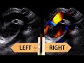 Left vs. Right aortic arch, how to identify in echocardiography ?