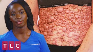 A Severe Case of Neurofibromatosis | Dr. Mercy