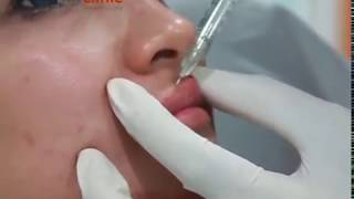 #TreatmentTheClinicID | Filler Bibir