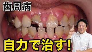 歯周病を治すならここを磨け！！