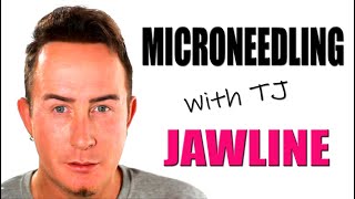 Microneedling Jaw and Chin Tutorial Treatment Chooser