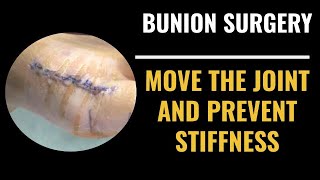 Recovering after bunion surgery how to move the joint and prevent stiffness