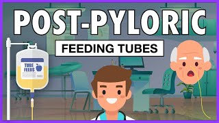 Post-Pyloric Feeding Tubes