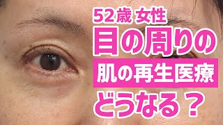 50代からの顔のたるみエイジングケア治療「肌の再生医療」ビフォーアフター｜1ヶ月検診