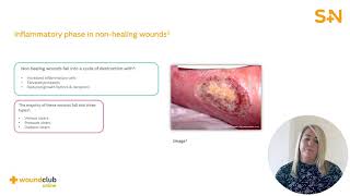 Wound Club Online | Module 3: Abnormal Healing (5min)