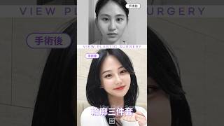 韓國必嫵·輪廓三件套案例｜韓國必嫵整形醫院View Plastic Surgery