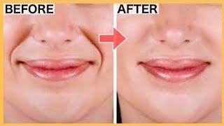 SMILE LINES (LAUGH LINES) REMOVAL AND FILL WITH KOREAN FACE EXERCISE & MASSAGE IN 2 WEEKS