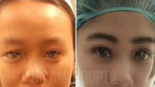 Asian Blepharoplasty Surgery | Eyelid Surgery Before and After