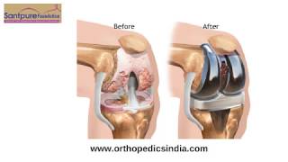Knee Replacement In Aurangabad | Knee pain Treatment | Orthopedic Surgeon In India
