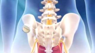 InterStim® Testing Procedure