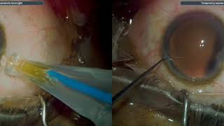 3D Surgery: Manual Phacoemulsification and MIGS using a Kahook Dual Blade