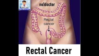Rectal cancer / Causes / Colorectal / Diagnosis / Pathology / Treatment / Surgery / Radiology / Mrcs