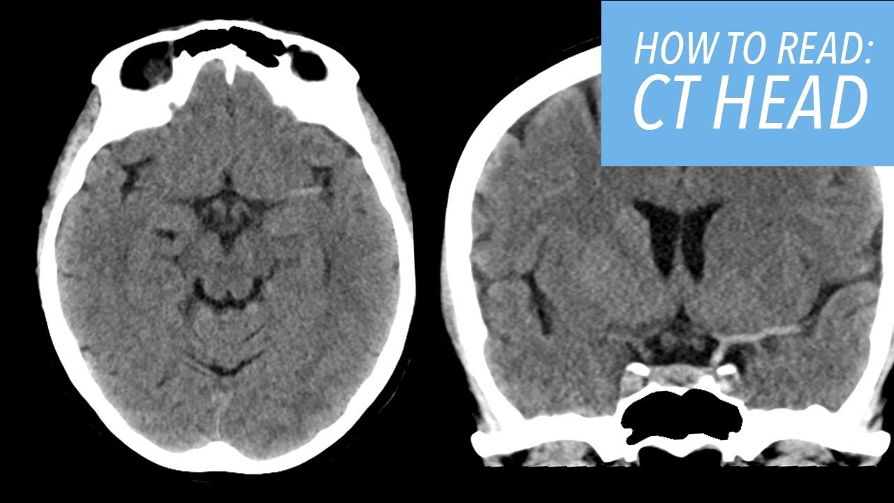 How To Read A Ct Head A Beginner S Approach Youtube