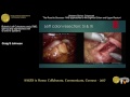 robotic left colectomy with ptme set up and approaches with si and xi systems