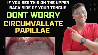 Dr Rudra| If you see this on the upper back side of your tongue DON'T WORRY Circumvallate Papillae