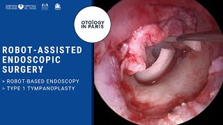 Robot-Based Endoscopic Tympanoplasty