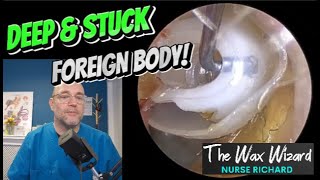 DEEP \u0026 STUCK FOREIGN BODY! 402 #ear #earwax #earwaxremoval #satisfying #foryou #fyp #earcleaning