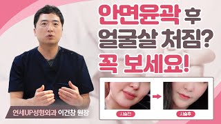 안면윤곽 후 얼굴살 처지나요? 사각턱 수술했는데 날렵한 턱선이 아니라면? 필수시청! - 연세UP업리프팅