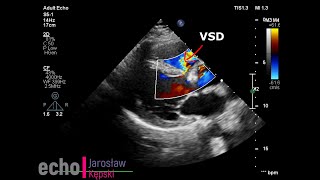 Ventricular Septal Defect #VSD #echocardiography echo congenital heart disease