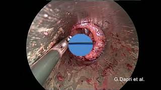 Double Transanal Endolaparoscopic Large Anal Canal and Low Rectum Polyps Resection