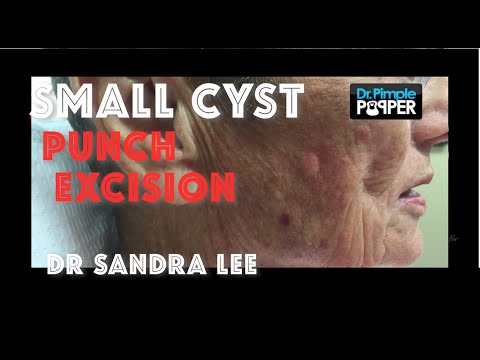 A Small Cyst On The Cheek Removed Via Punch Biopsy - YouTube