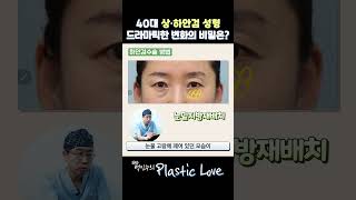 [40대 눈성형] 상·하안검수술의 정석!💯