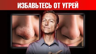 Как НАВСЕГДА избавиться от черных угрей и сальных нитей? 🧐