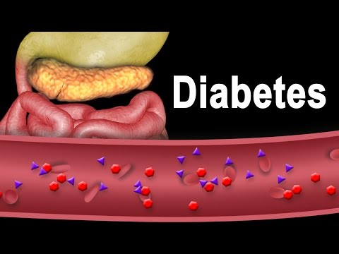 Diabetes Type 1 and Type 2, Animation. Diabetes Type 1 and Type 2, Animation.
