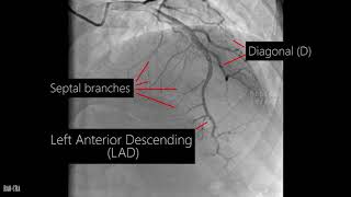Coronary artery anatomy - Coronary angiogram