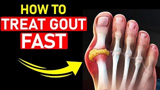 🔥Top 7 Gout Foot & Big Toe HOME Treatments [+1 BIG SECRET]