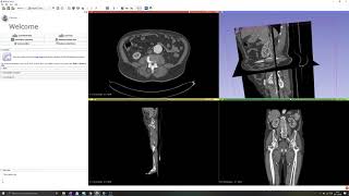 3D Slicer Tutorial #8: Navigation, Location and Cropping