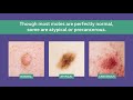 Atypical Moles vs. Precancerous Moles vs. Normal Moles | SERO