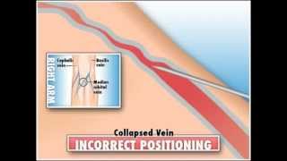 Collapsed vein